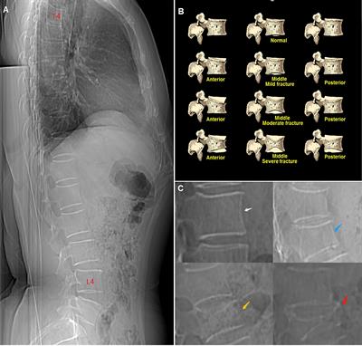 Differences in spine volumetric bone mineral density between grade 1 vertebral fracture and non-fractured participants in the China action on spine and hip status study